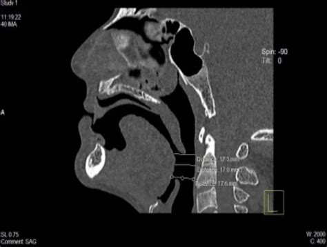 Changes in upper airway volume in edentulous obstructive sleep apnea ...