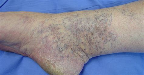Skin discoloration inside ankle ~ Top Secret Skin Tips