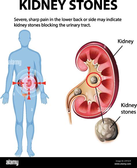 Illustration of kidney stones causing severe pain Stock Vector Image & Art - Alamy