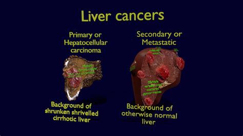 Liver Cancer Primary Metastatic - Buy Royalty Free 3D model by Deepankar.Parmar [1ef62bc ...