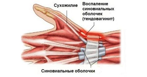 Сухожилия кисти: где находятся, повреждение сгибателей и разгибателей ...