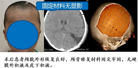 3D打印颅骨模型拯救了鼻子被骨头堵塞的澳大利亚婴儿 - 知乎