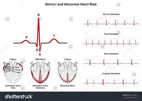 Abnormal Electrocardiogram