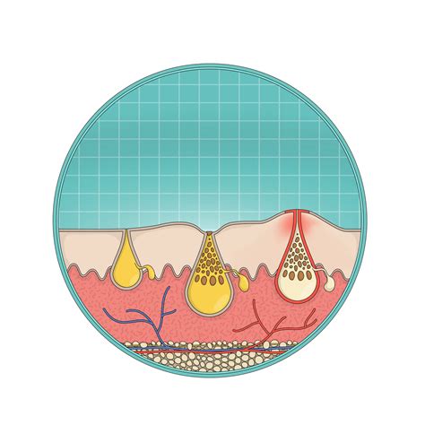 What are Clogged Pores? | How to Get Rid of Clogged Pores | Soft ...