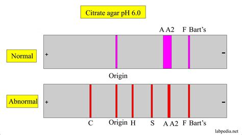 Lab Test Hemoglobin Electrophoresis at George Jelks blog