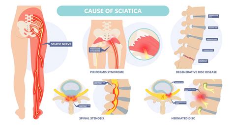 Sciatica: Causes, conservative care, surgery, and injection treatments - Joint Rehab and Sports ...