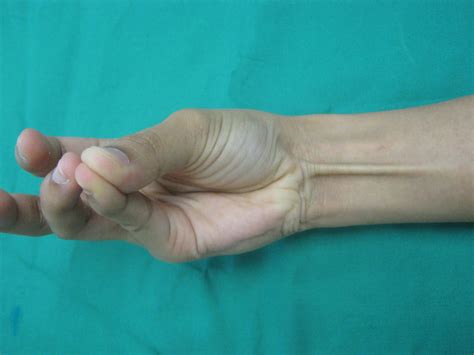 Muscle of the Day: Palmaris Longus — Experience Physical Therapy - Buffalo Grove, IL