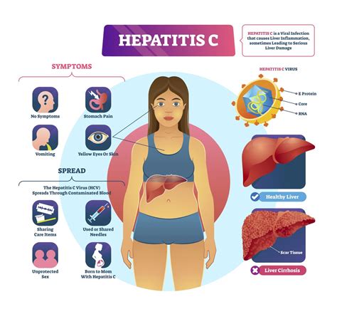 Hepatitis Symptoms In Women Overview Of Viral Hepatitis