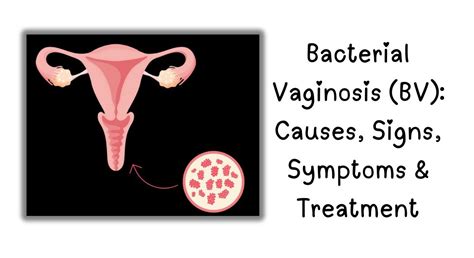 Bacterial Vaginosis (BV): Causes, Signs, Symptoms & Treatment ...
