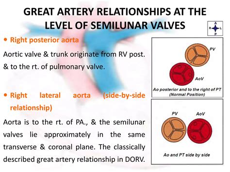 Double outlet right ventricle | PPTX