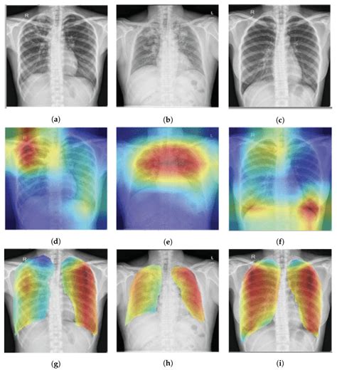 Weak Localization of Radiographic Manifestations in Pulmonary ...