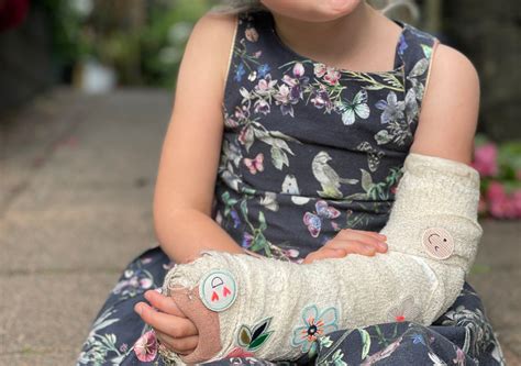 Fracture Plaster Cast Treatment at Eliza Sizer blog