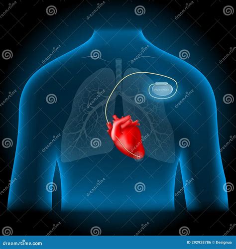 Cardiac pacemaker location stock vector. Illustration of human - 292928786