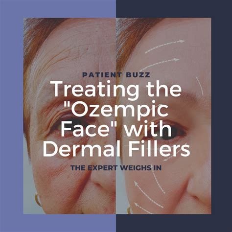 Treating the "Ozempic Face" with Dermal Fillers - Next Steps in Dermatology