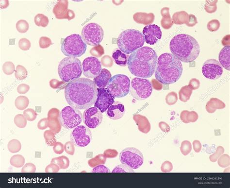 Leukemia Blood Cells Blast Cells Immature Stock Photo 2266261893 ...