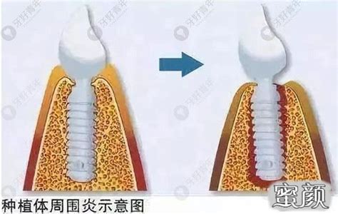 当牙齿缺失时，选择镶牙or种植牙？-爱康健齿科