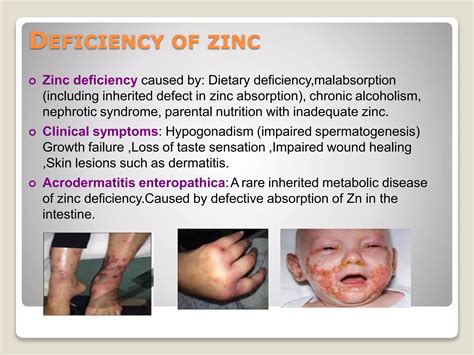 Zinc poisoning.pptx
