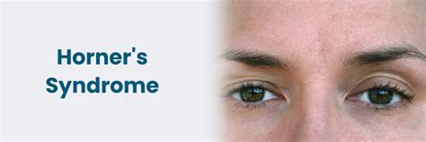 Horner's Syndrome: Causes, Symptoms and Diagnosis