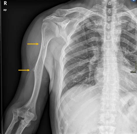 Hereditary multiple exostoses with chondrosarcoma transformation | Eurorad