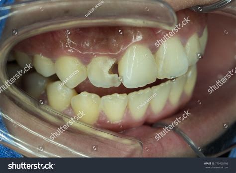 Front Tooth Root Canal