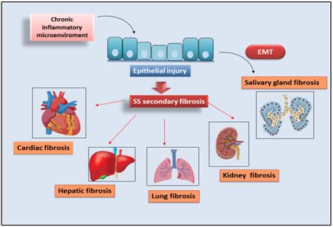 Sjögren’s Syndrome-Related Organs Fibrosis | Encyclopedia MDPI