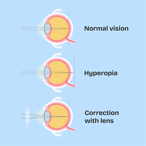 What Does Farsighted Mean? Hyperopia Explained