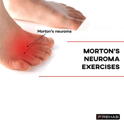 Mortons Neuroma Treating Morton's Neuroma: Surgery To Save The Nerve