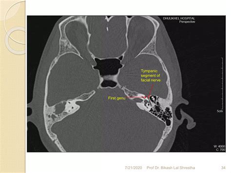 How to read ct scan temporal bone - A dhulikhel hospital, kathmandu ...