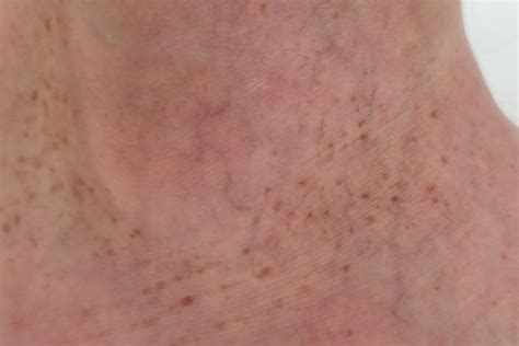 Brown spots on ankles and feet : r/DermatologyQuestions