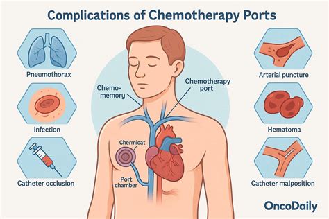 What Is a Chemotherapy Port? Uses, Benefits and Complications - OncoDaily