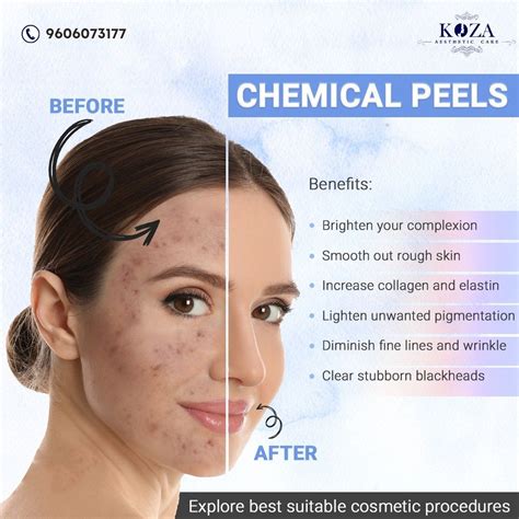 What is a chemical peel – Artofit