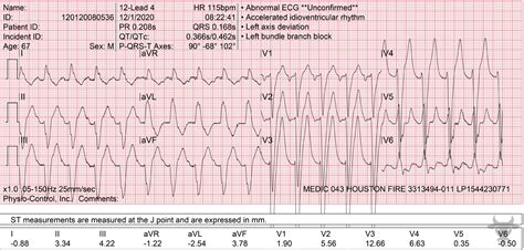 Left Bundle Branch Block | ECG Stampede