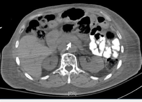 Axial CT scan of the abdomen showing normal appearance of the pancreas ...