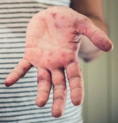 New Tomato flu variant creates health scare among kids in several states