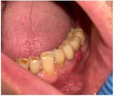 The Temporary Mental Nerve Paresthesia as an Outcome of Dentigerous ...