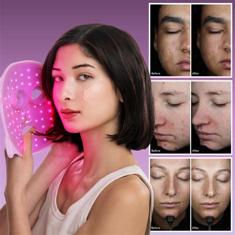 Exploring Pro-Approved Acne Care and The Latest Omnilux Clear Clinical