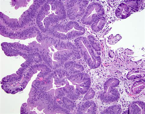 Pathology Outlines - Barrett related dysplasia