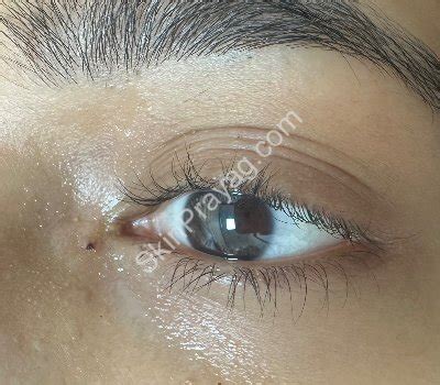 Milia removal Images | Skin Prayag