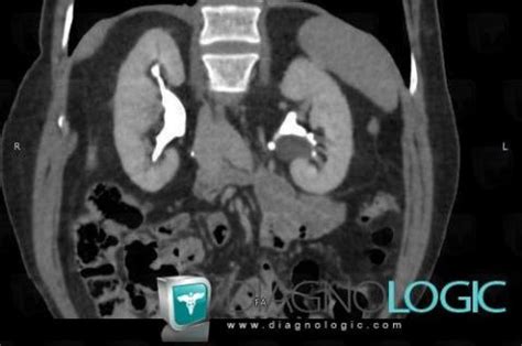 Kuvatulokset haulle parapelvic cyst kidney