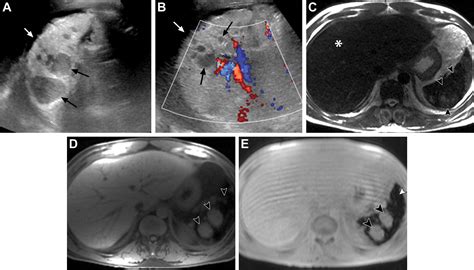 Manifestations of Sickle Cell Disorder at Abdominal and Pelvic Imaging | RadioGraphics