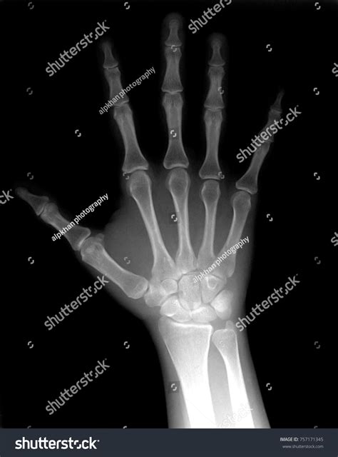 Hand Xray