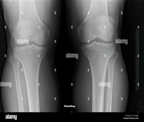 X-ray film of healthy male knees Stock Photo - Alamy