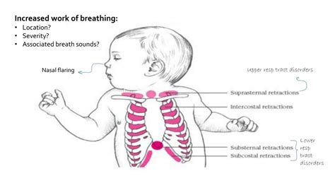 What Is Retraction Breathing In Babies at Nancy Ramirez blog