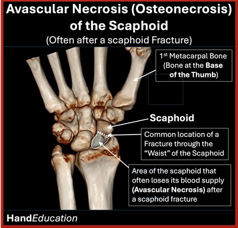 Osteonecrosis of the Scaphoid - Hand Education