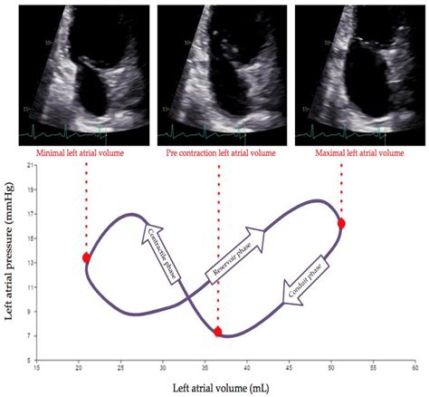 Current and Clinically Relevant Echocardiographic Parameters to Analyze ...