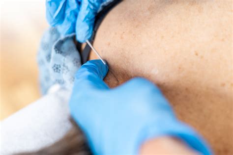 Trigger Point Dry Needling — Dr Amy O'Donnell Chiropractic Physician