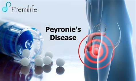 Peyronie's Disease | Premilife - Homeopathic Remedies