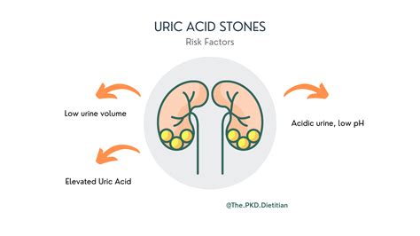Kidney Stone Risk & Polycystic Kidney Disease, are they connected?