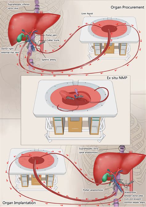 Liver Transplant For Liver Failure