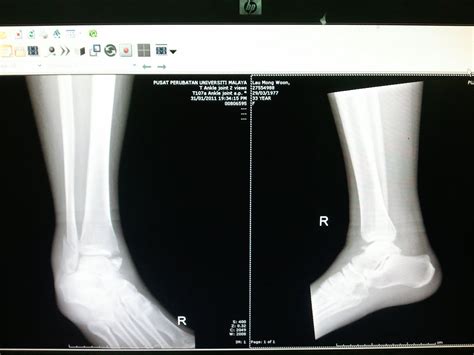 Kokenko: Tibia and fibula fracture.